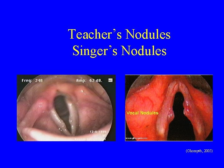 Teacher’s Nodules Singer’s Nodules (Ghorayeb, 2005) 
