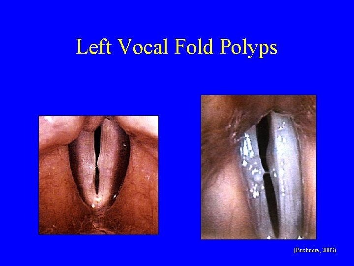 Left Vocal Fold Polyps (Buckmire, 2003) 