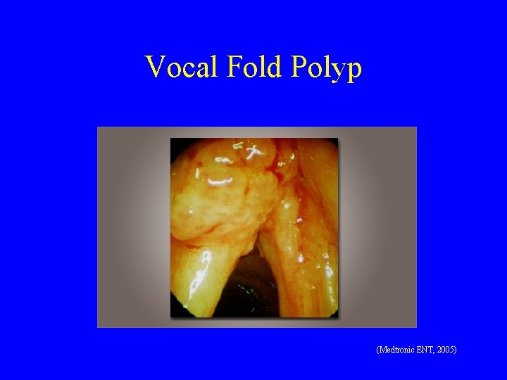 Vocal Fold Polyp (Medtronic ENT, 2005) 