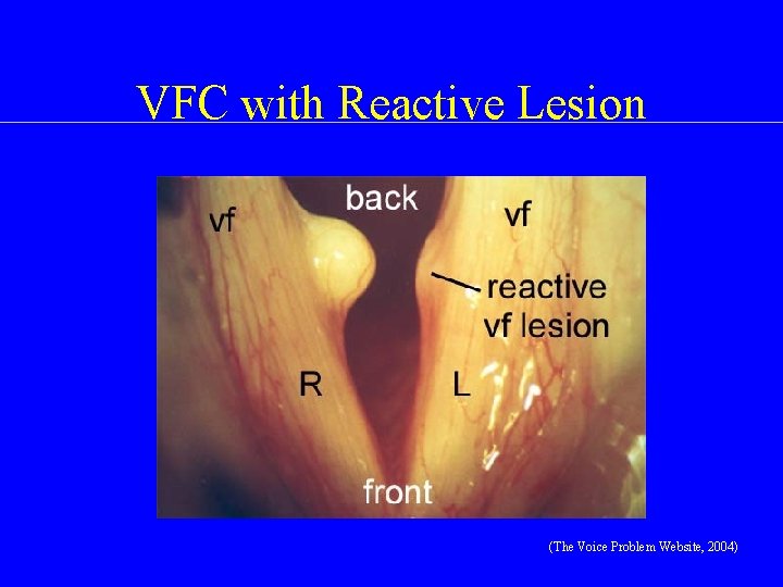 VFC with Reactive Lesion (The Voice Problem Website, 2004) 