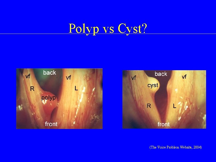 Polyp vs Cyst? (The Voice Problem Website, 2004) 