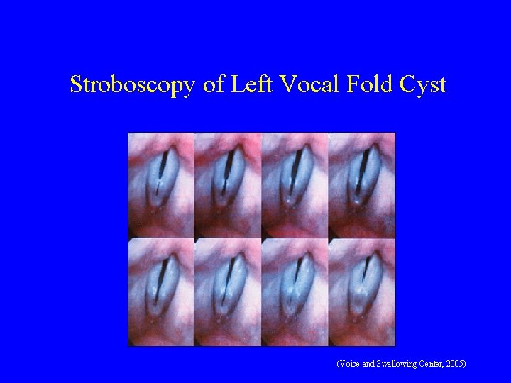 Stroboscopy of Left Vocal Fold Cyst (Voice and Swallowing Center, 2005) 
