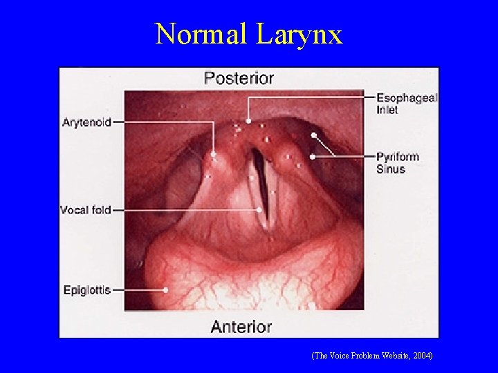 Normal Larynx (The Voice Problem Website, 2004) 