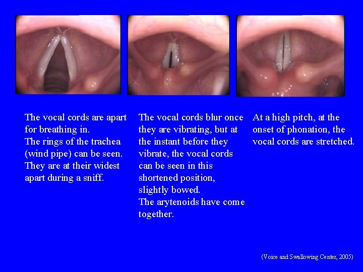 The vocal cords are apart for breathing in. The rings of the trachea (wind