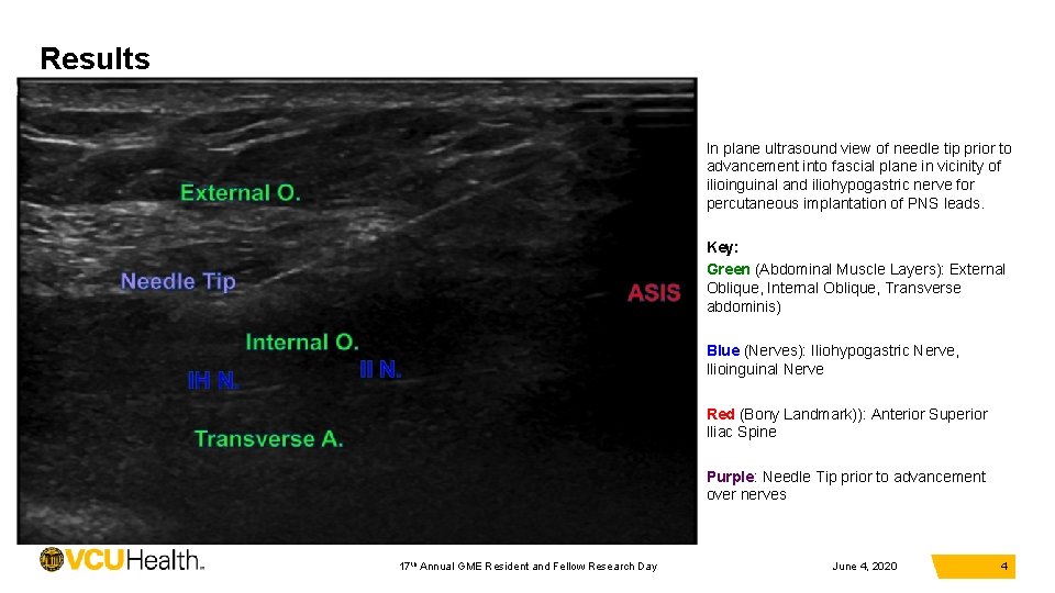 Results In plane ultrasound view of needle tip prior to advancement into fascial plane