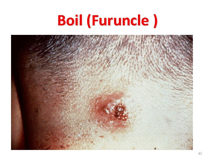 Boil (Furuncle ) 61 