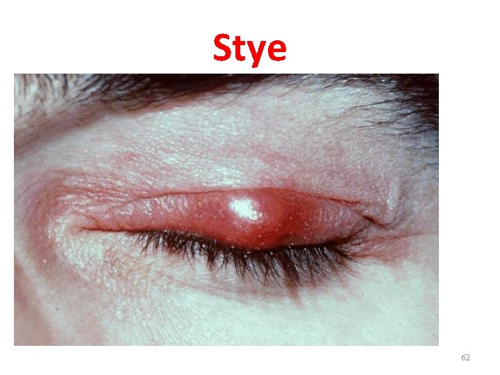 Stye 62 