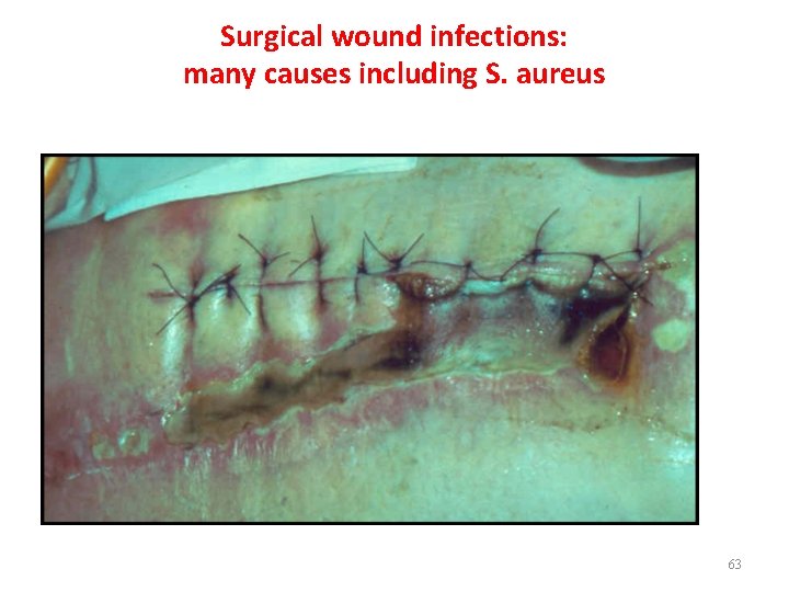 Surgical wound infections: many causes including S. aureus 63 