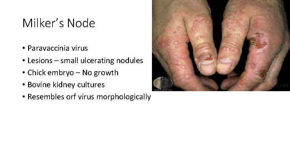 Milker’s Node • Paravaccinia virus • Lesions – small ulcerating nodules • Chick embryo
