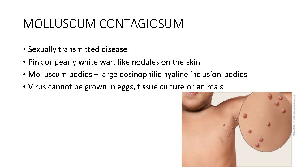 MOLLUSCUM CONTAGIOSUM • Sexually transmitted disease • Pink or pearly white wart like nodules