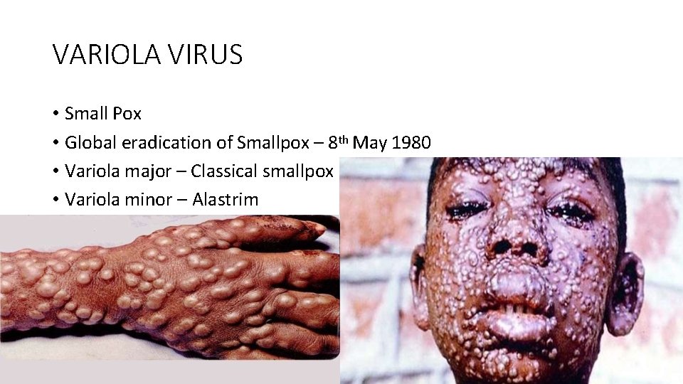 VARIOLA VIRUS • Small Pox • Global eradication of Smallpox – 8 th May