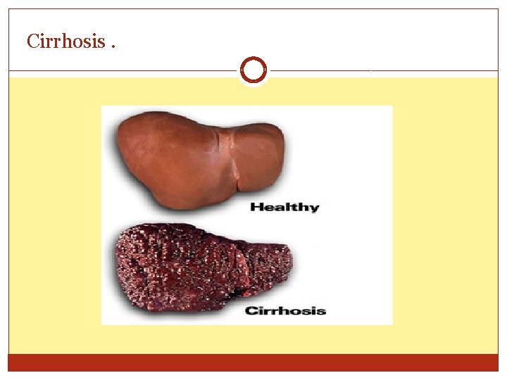 Cirrhosis. 