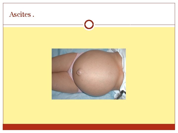 Ascites. 