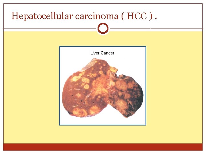 Hepatocellular carcinoma ( HCC ). 