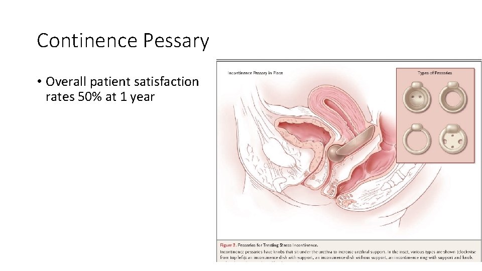 Continence Pessary • Overall patient satisfaction rates 50% at 1 year 