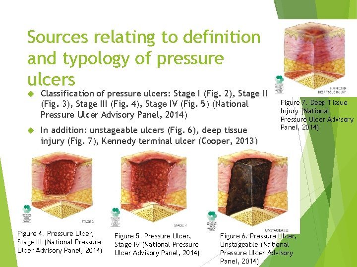 Sources relating to definition and typology of pressure ulcers Classification of pressure ulcers: Stage