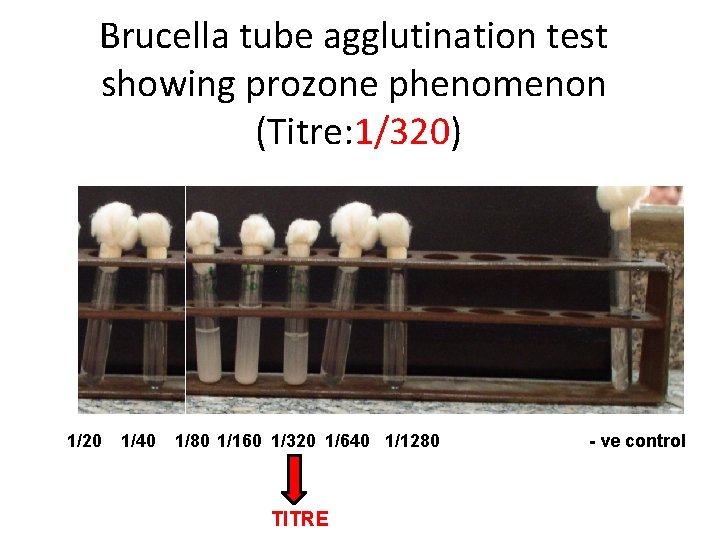 Brucella tube agglutination test showing prozone phenomenon (Titre: 1/320) 1/20 1/40 1/80 1/160 1/320