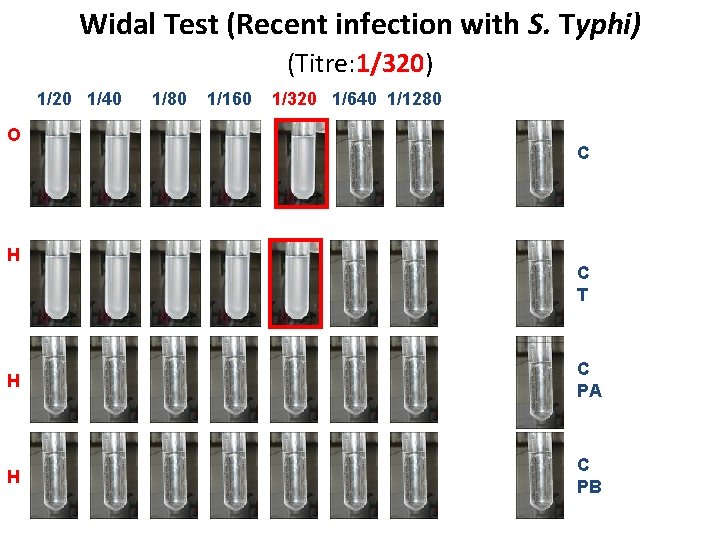 Widal Test (Recent infection with S. Typhi) (Titre: 1/320) 1/20 1/40 O H 1/80