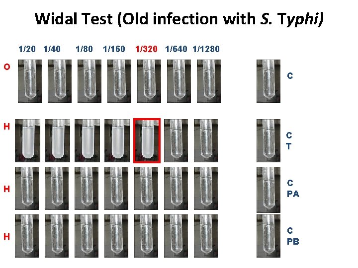 Widal Test (Old infection with S. Typhi) 1/20 1/40 O H 1/80 1/160 1/320