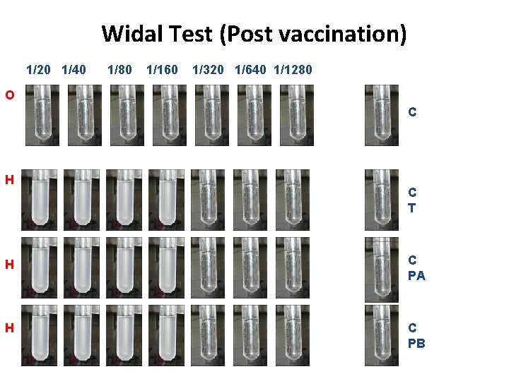 Widal Test (Post vaccination) 1/20 1/40 1/80 1/160 1/320 1/640 1/1280 O C H