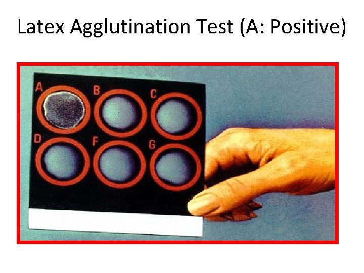 Latex Agglutination Test (A: Positive) 