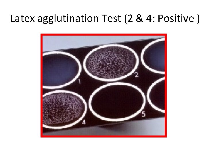 Latex agglutination Test (2 & 4: Positive ) 