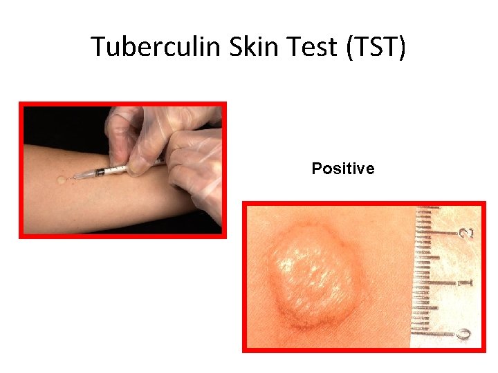 Tuberculin Skin Test (TST) Positive 