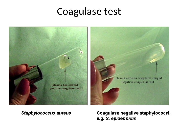 Coagulase test Staphylococcus aureus Coagulase negative staphylococci, e. g. S. epidermidis 