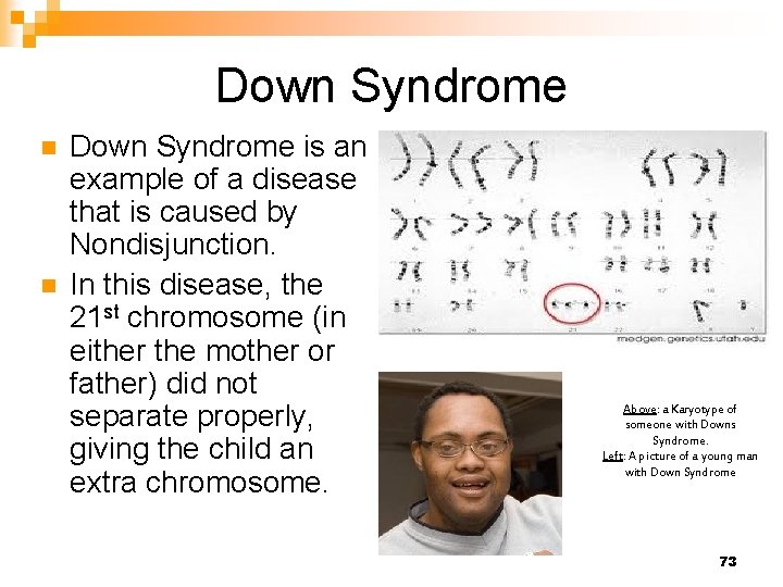 Down Syndrome n n Down Syndrome is an example of a disease that is