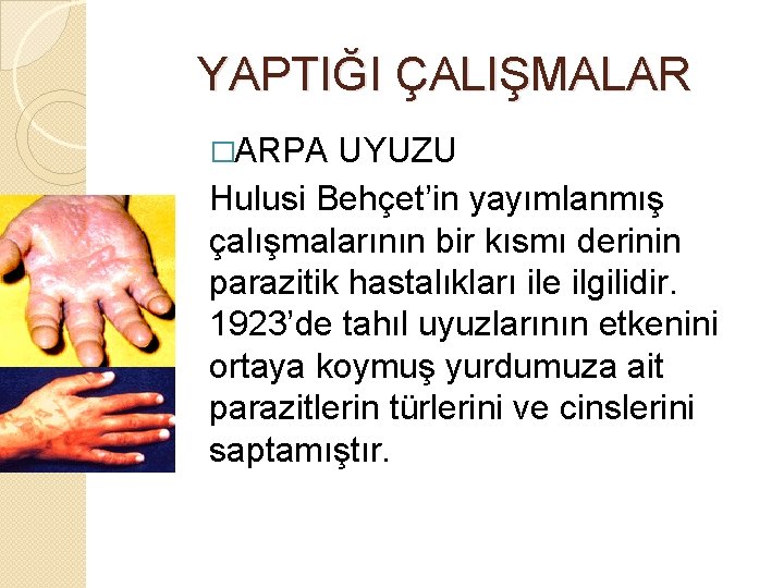 YAPTIĞI ÇALIŞMALAR �ARPA UYUZU Hulusi Behçet’in yayımlanmış çalışmalarının bir kısmı derinin parazitik hastalıkları ile