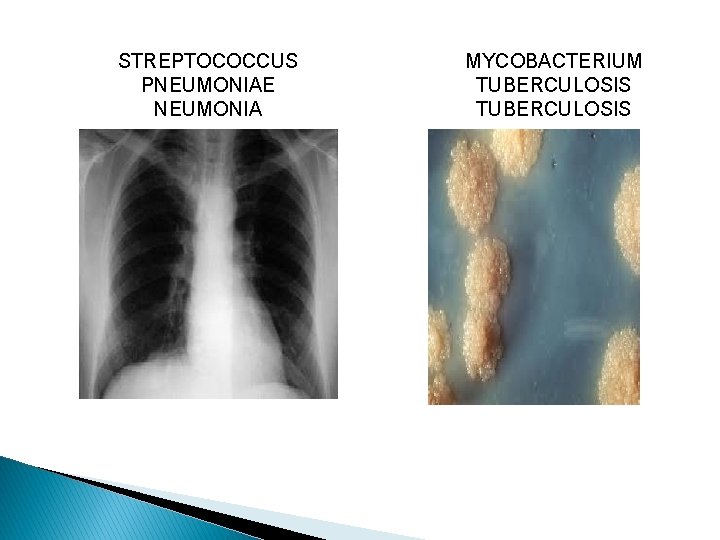 STREPTOCOCCUS PNEUMONIAE NEUMONIA MYCOBACTERIUM TUBERCULOSIS 