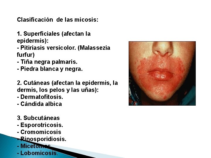 Clasificación de las micosis: 1. Superficiales (afectan la epidermis): - Pitiriasis versicolor. (Malassezia furfur)