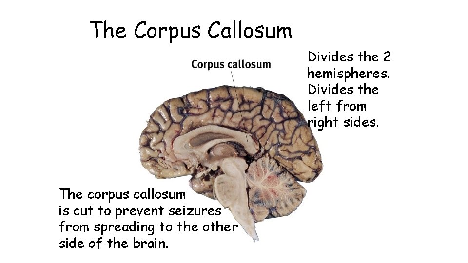 The Corpus Callosum Divides the 2 hemispheres. Divides the left from right sides. The