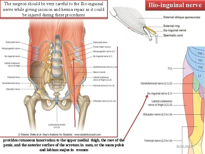 The surgeon should be very careful to the Ilio-inguinal nerve while giving incision and
