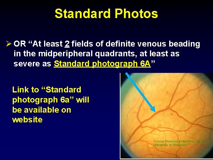 Standard Photos Ø OR “At least 2 fields of definite venous beading in the
