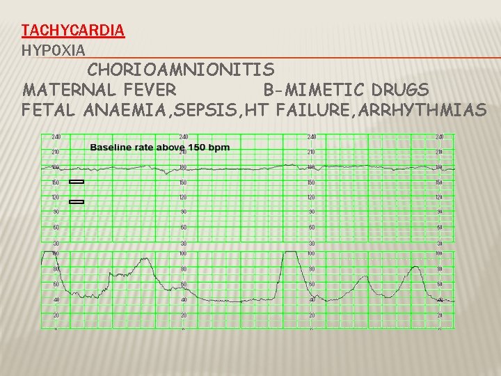 TACHYCARDIA HYPOXIA CHORIOAMNIONITIS MATERNAL FEVER B-MIMETIC DRUGS FETAL ANAEMIA, SEPSIS, HT FAILURE, ARRHYTHMIAS 