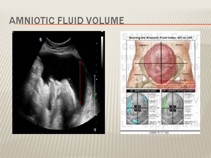 AMNIOTIC FLUID VOLUME 