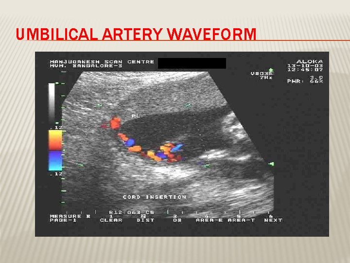 UMBILICAL ARTERY WAVEFORM 