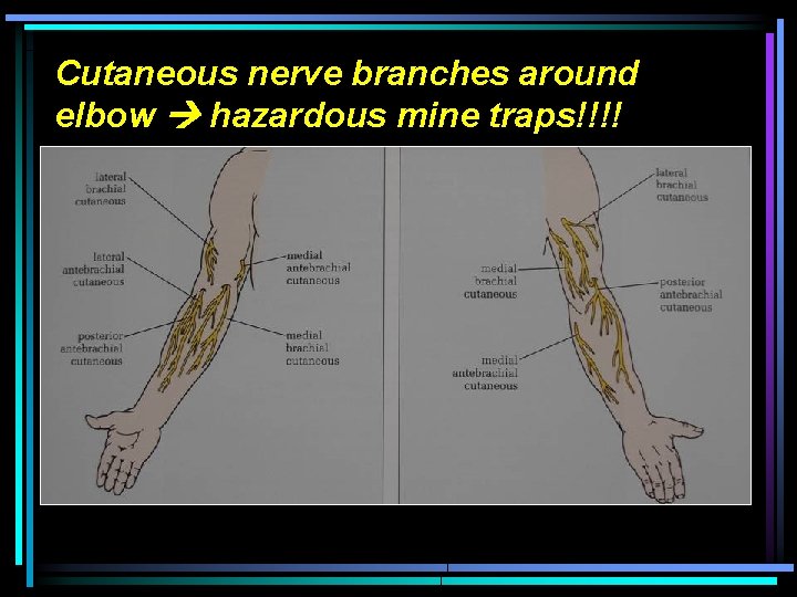 Cutaneous nerve branches around elbow hazardous mine traps!!!! 