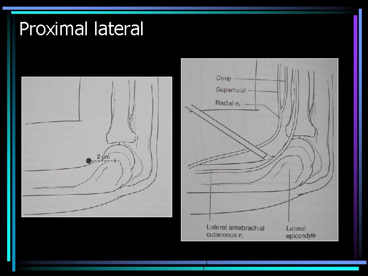 Proximal lateral 