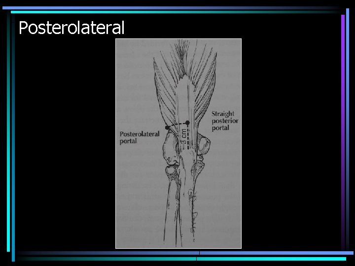 Posterolateral 
