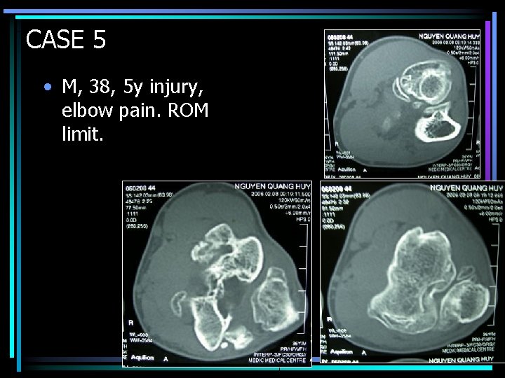 CASE 5 • M, 38, 5 y injury, elbow pain. ROM limit. 