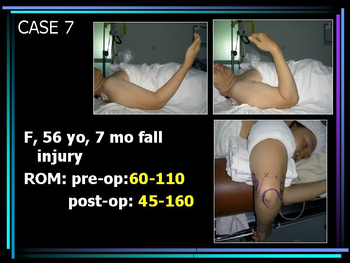 CASE 7 F, 56 yo, 7 mo fall injury ROM: pre-op: 60 -110 post-op: