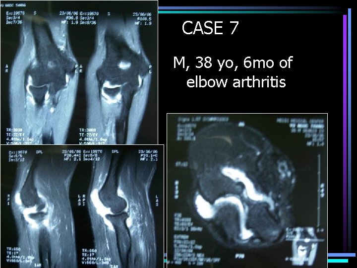 CASE 7 M, 38 yo, 6 mo of elbow arthritis 