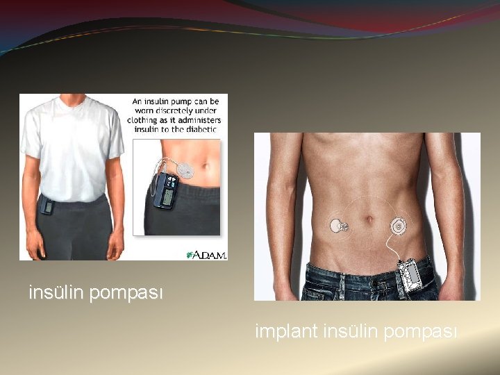 insülin pompası implant insülin pompası 