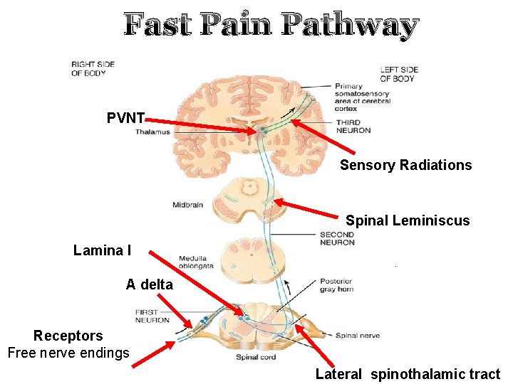 Fast Pain Pathway PVNT Sensory Radiations Spinal Leminiscus Lamina I A delta Receptors Free