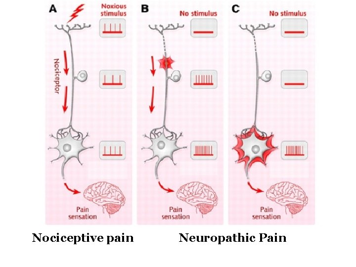 Nociceptive pain Neuropathic Pain 