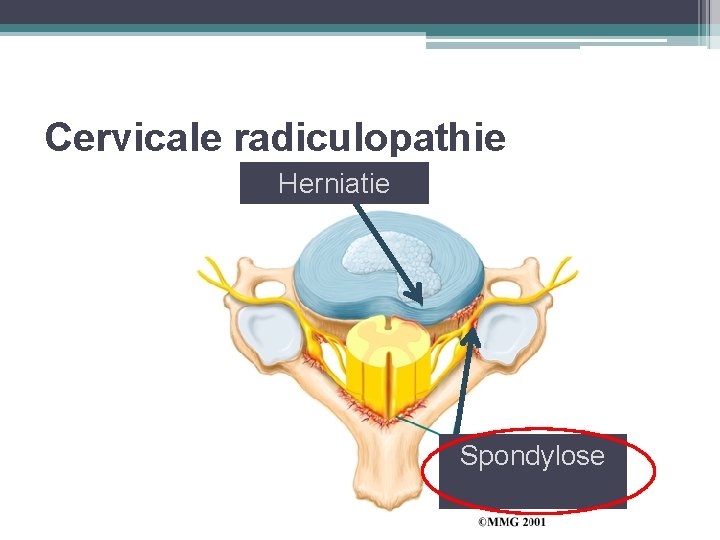 Cervicale radiculopathie Herniatie Spondylose 