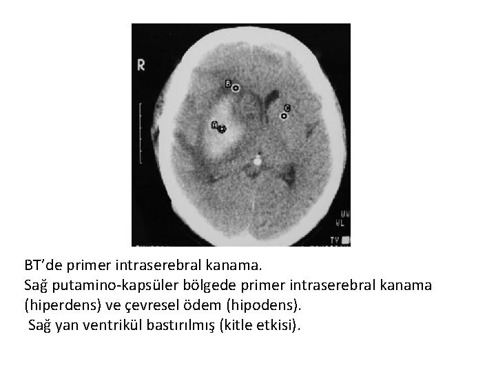 BT’de primer intraserebral kanama. Sağ putamino-kapsüler bölgede primer intraserebral kanama (hiperdens) ve çevresel ödem