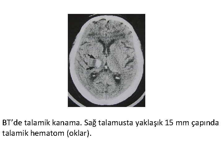 BT’de talamik kanama. Sağ talamusta yaklaşık 15 mm çapında talamik hematom (oklar). 